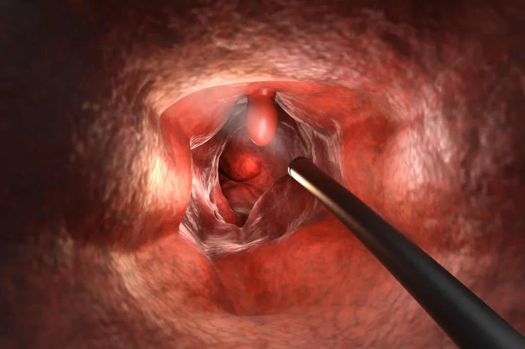 A flexible sigmoidoscopy showing a scope inside the colon for detecting a polyp.