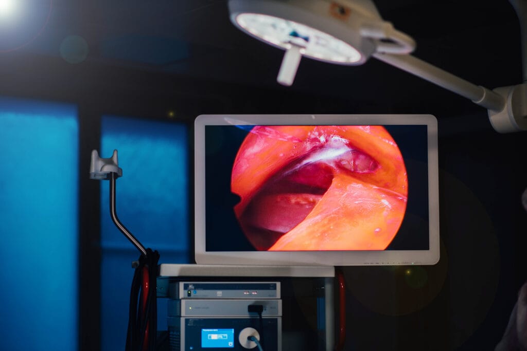 Endoscopic ultrasound (EUS) procedure displayed on a medical monitor in an examination room.