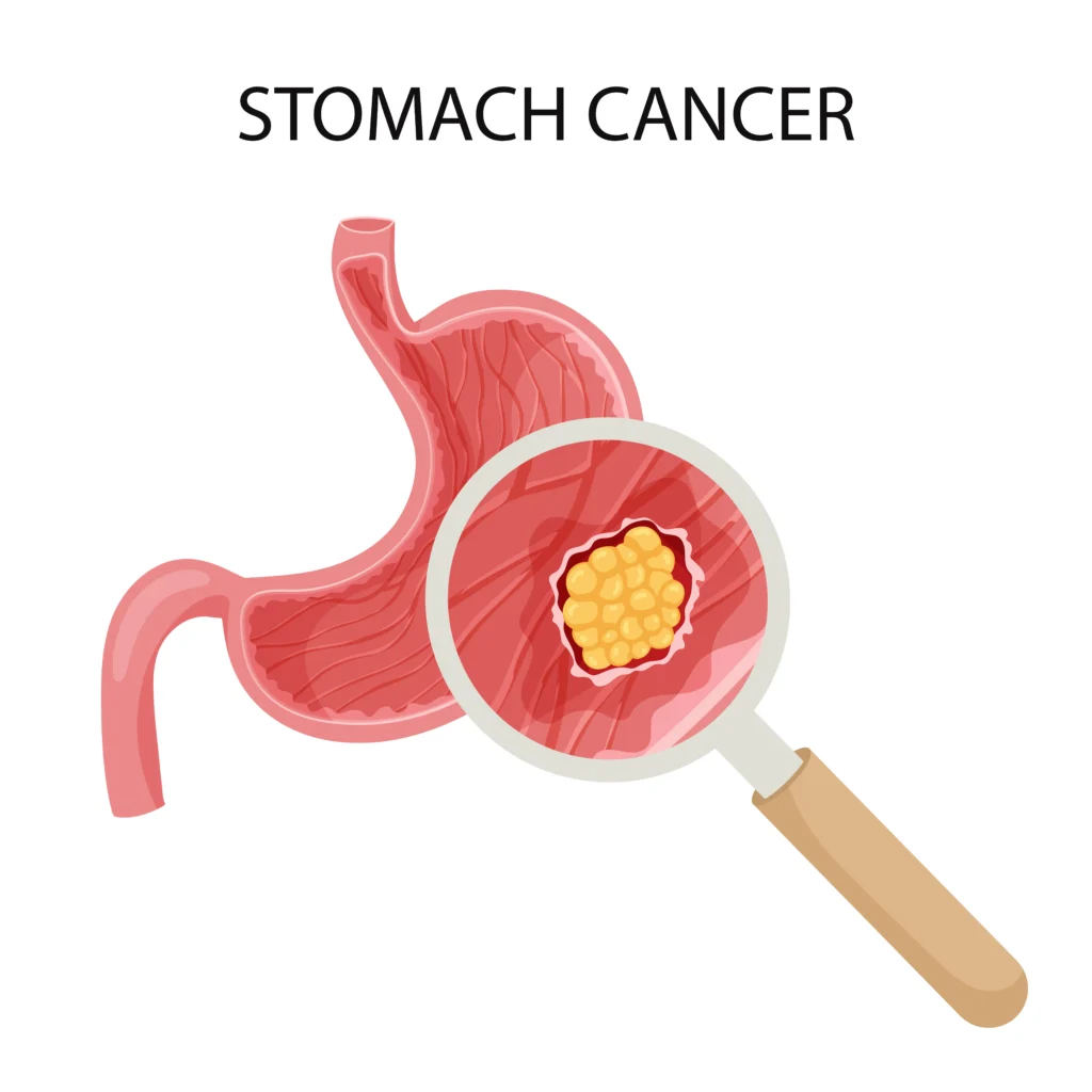 GI cancers 