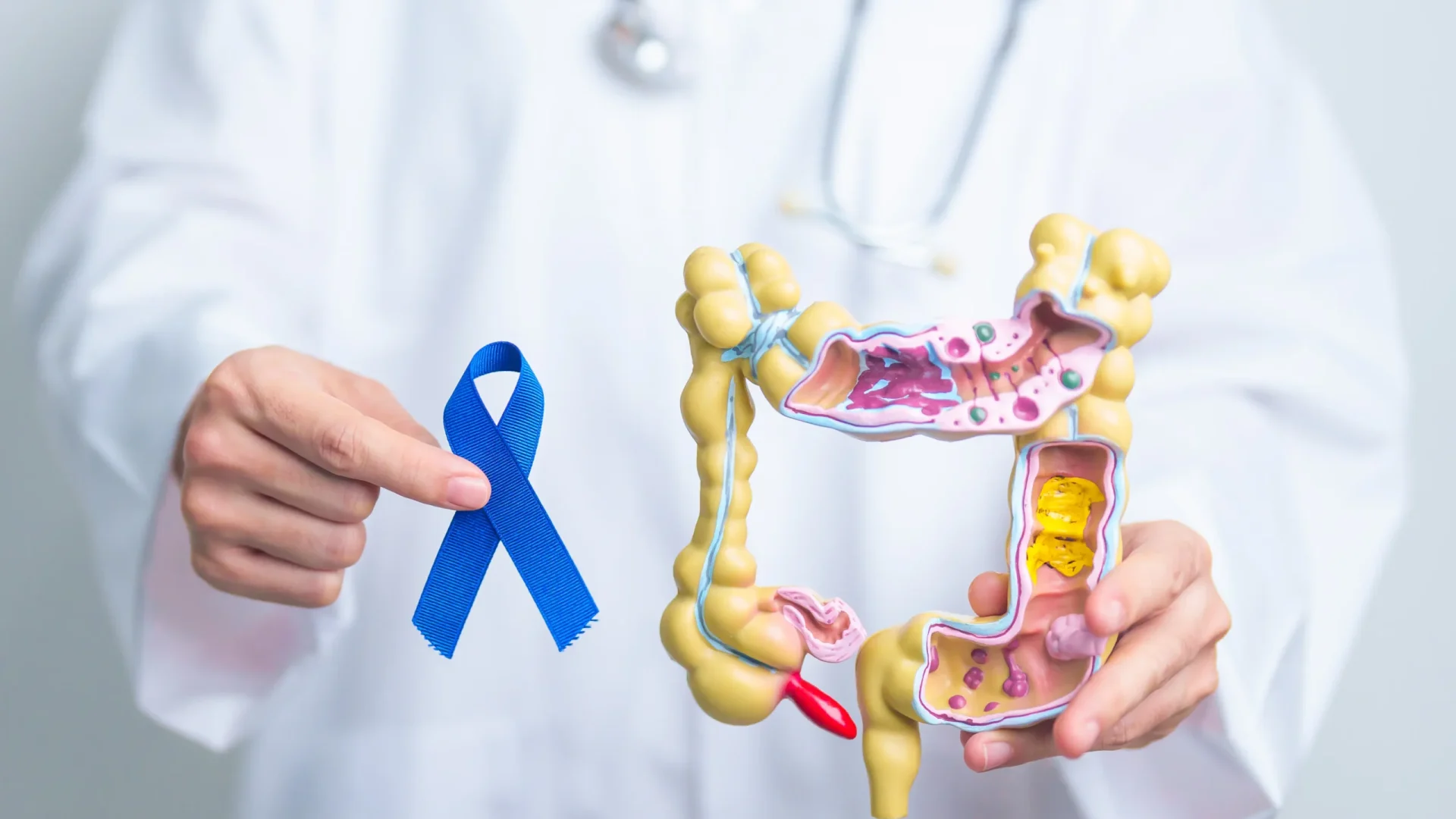 Colon Cancer