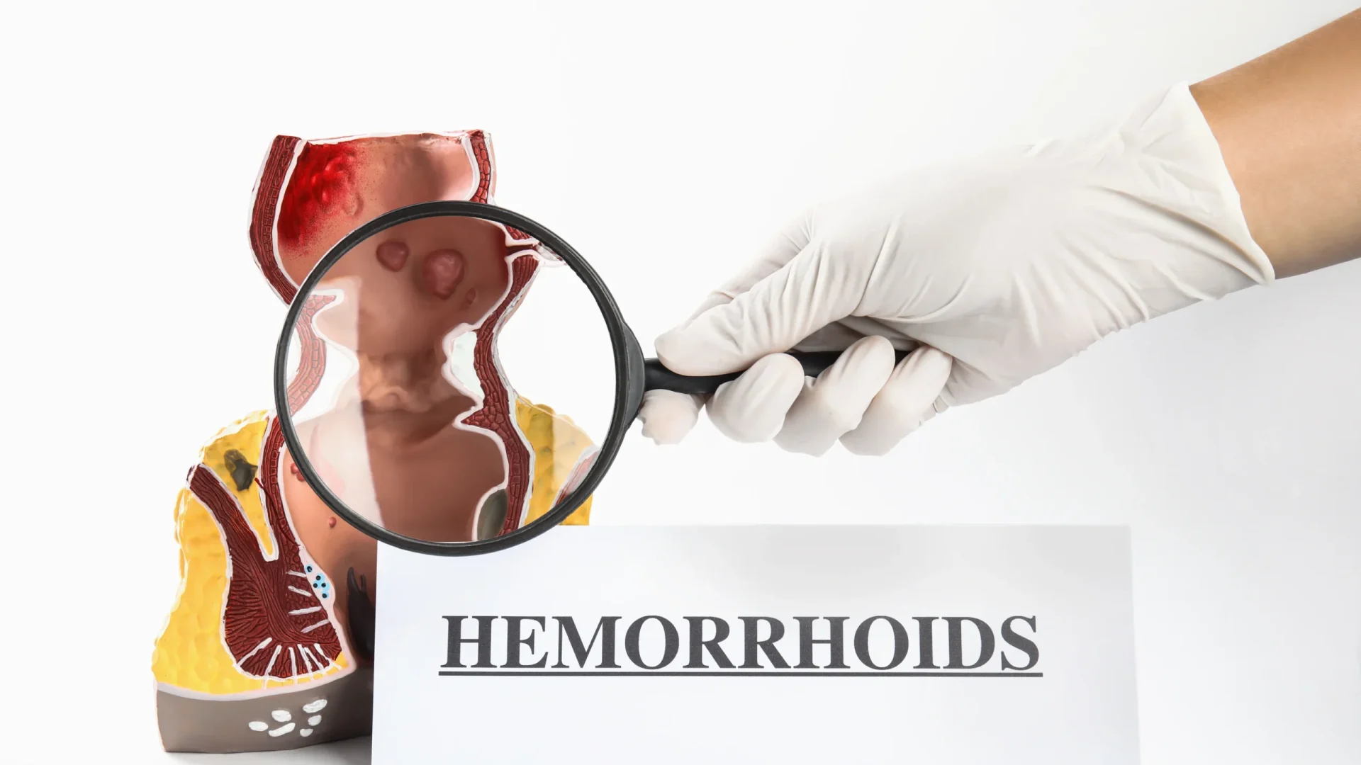 Doctor examining an anatomical model with a magnifying glass to explain hemorrhoid treatment.